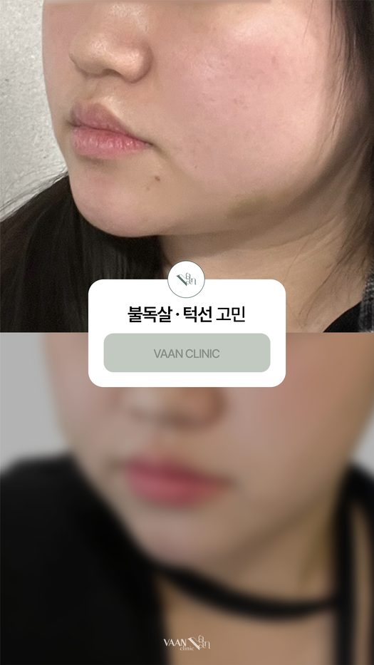 불독살 · 턱선 고민