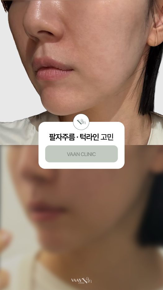 팔자주름 · 턱라인 고민