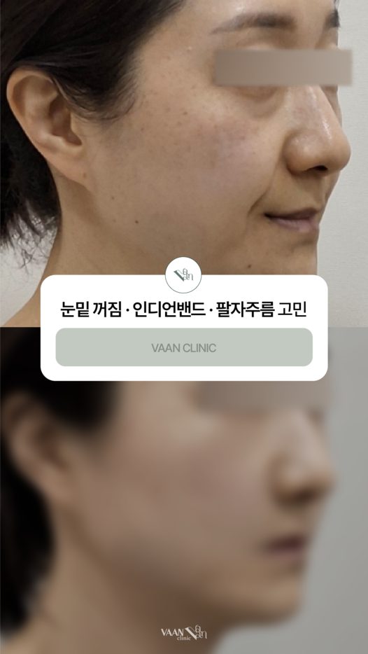 눈밑 꺼짐 · 인디언밴드 · 팔자주름 고민