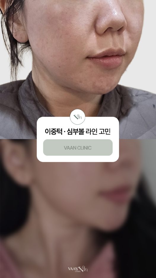 이중턱 · 심부볼 라인 고민