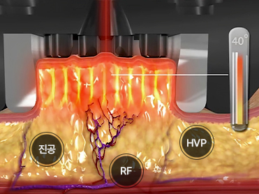 효과적인 지방 감소의 세 가지 Step