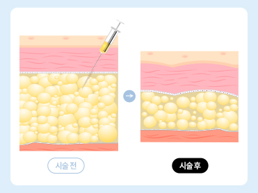 지방 세포 수 감소 및 노폐물 배출 가속화
