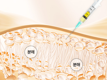 셀룰라이트 개선 집중