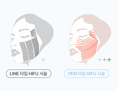 리프테라2 고객 맞춤형 시술